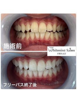 ホワイトニングサロン 京都烏丸店/ホワイトニング施術後