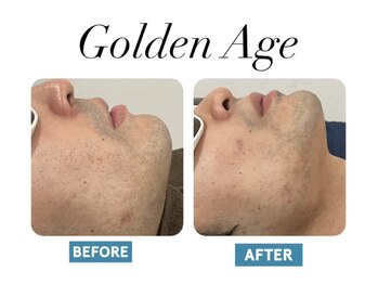 ゴールデンエイジ(Golden Age)/【ヒゲ脱毛】Before&After