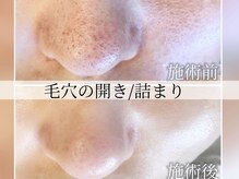 ハイフン(HIFUN)/【毛穴開き/角栓】毛穴洗浄