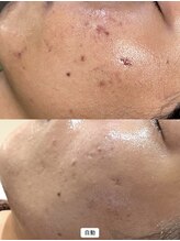 レシェルサロン(Lechelle Salon)/ハーブピーリング＋エステダーマ