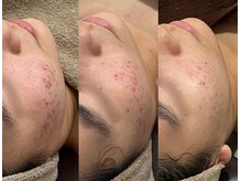 TD 鵜沼店/ハーブピーリング