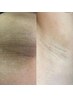 【ワキの黒ずみ、ブツブツ解消】プラズマで古い角質を弾き飛ばす！　¥4500