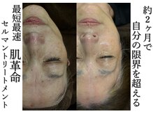 60代モニター様シミ/毛穴からの解放!最速で肌を変化韓国発肌管理