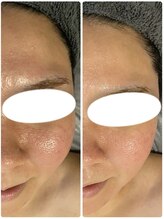 エヌ(enu)/炭酸ガスパック/フェイシャル