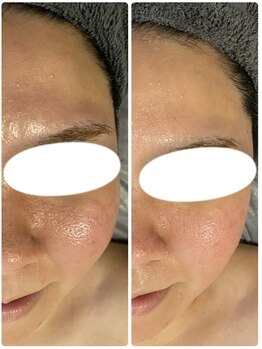 エヌ(enu)/炭酸ガスパック/フェイシャル