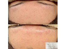 ピエル 柏店(PIEL)/毛穴ケア×アンストレス