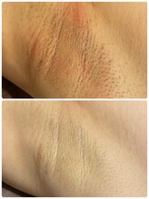 アネル 新都心店(anel)/ワキ脱毛　《那覇》