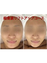 ビジュラン グロスキングツヤ王(Bijuran GlossKingツヤ王)/超音波小顔リフト１回の変化