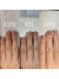 自爪育成/深爪育成/自爪風仕上げ