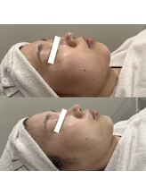 ウィール 栄 矢場町店(WE:LL)/毛穴洗浄×栄養パック