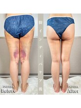 術後の女神 大阪本町店/ダウンタイムケア・インディバ