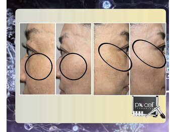 ウィズサロン 天神大名店(withサロン)/プロセル肌診断モニター付き