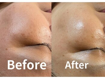 デン(DEN)/プラズマニアでシミ、くすみ改善