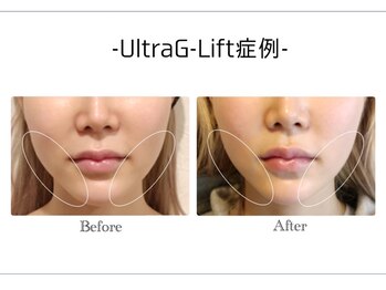 アンドエピ(&epi)/韓国痩身フェイシャル症例写真１