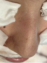 ウル 下北沢(Ulu)/韓国式３D毛穴洗浄