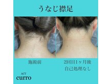アクト クロ(ACT curro)/【うなじ襟足】脱毛施術例