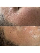 ヴィーナス(Venus)/エステ版ポテンツァ　5回