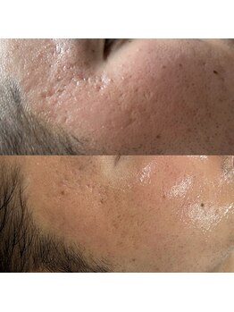 ヴィーナス(Venus)/エステ版ポテンツァ　5回