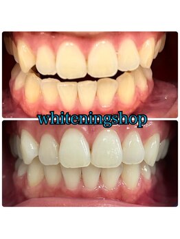 ホワイトニングショップ 大阪玉造店/Before&After美白ホワイトニング