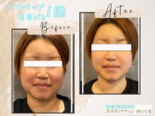 めいてる/【リフトアップ美容ばり】１回