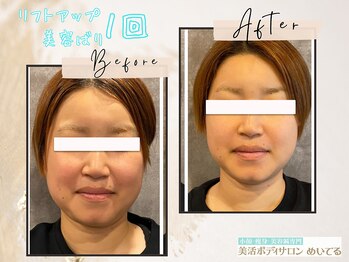 めいてる/【リフトアップ美容ばり】1回