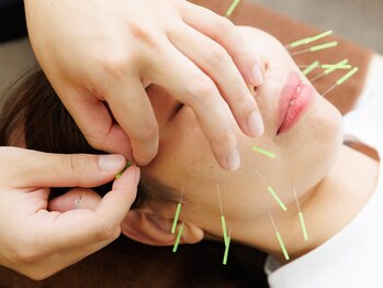 大宮ウィル鍼灸整骨院/顔鍼施術鍼灸小顔鍼リフトアップ