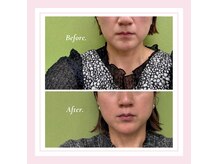 ル フラーズ(Les Fleurs)の雰囲気（マリオネットライン、口元は体の施術が必須です）