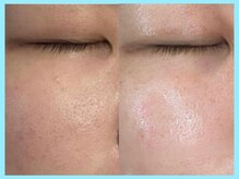 ハーブピーリング 名古屋/TETEピール導入★