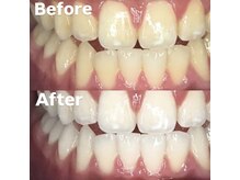 ホワイトニングビューティー 光の森店(WHITENING BEAUTY)/ホワイトニング♪