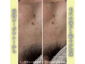 ハニエル(Haniel)/カーボキシー症例