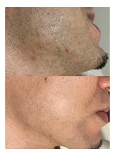 ジェムの森/ひげ脱毛 before after写真