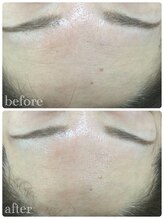 メイユール(MEILLEUR)/光フェイシャル1回