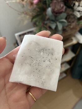 レーヌ(Reine)/ヒゲ脱毛で抜けた毛☆