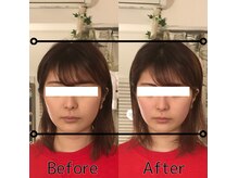 鍼灸サロン mの雰囲気（Before（左）→Ａfter（右）美顔コース1回施術　#美容鍼）