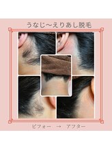 ノノ(nono)/うなじ～えりあし脱毛♪