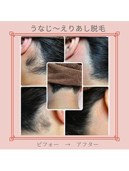 ノノ(nono)/うなじ～えりあし脱毛♪