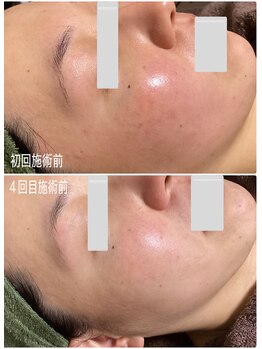 ブライトリー(Brightly)/最新光エステでシミケア肌質改善