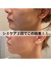 【当て放題】時間で選べるシミケア　10分¥7700 15分￥11000 20分¥14000 
