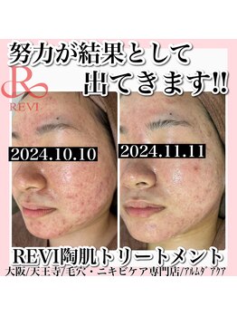 アルムダアクア 天王寺店(Aleumda AQUA)/ハーブピーリング/大阪/天王寺