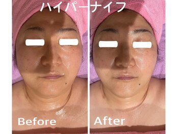 カスミソウ/リフトアップでスッキリ小顔