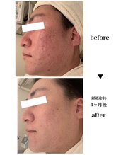 ジェニックサロン グランドギンザ ひたちなか(GENIC SALON GRAND GINZA)/メンズ毛穴・ニキビ・毛穴