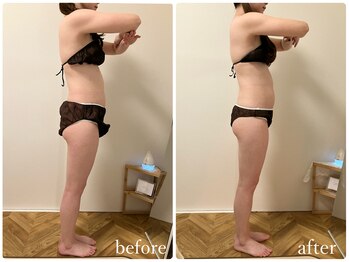 リリィブラン(Lily branc)/ブライダル痩身/背中+二の腕+肩