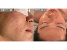 マリーボーテ 名古屋店/【ピーリング歴２年】人生激変