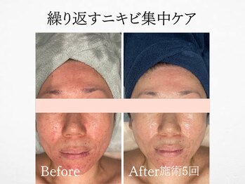 アンドミルル(and Milulu)/【繰り返すニキビ集中ケア】