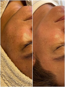 デン(DEN)/シミ、くすみ