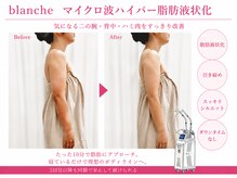 オリエンタルローザ 表参道(Oriental Rosa)/マイクロ波ハイパー脂肪液化術！