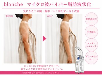 オリエンタルローザ 表参道(Oriental Rosa)/マイクロ波ハイパー脂肪液化術！