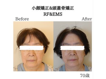 RKY/80分コースの小顔矯正(1回)