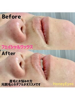 ハニーアイズ(Honey Eyes)/【女性wax】脱毛フェイシャルwax
