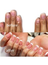 マニュコクーン(ManuCocoon)/爪育成　深爪　巻き爪　大阪市